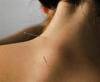 Acupunture needle inserted in the neck
